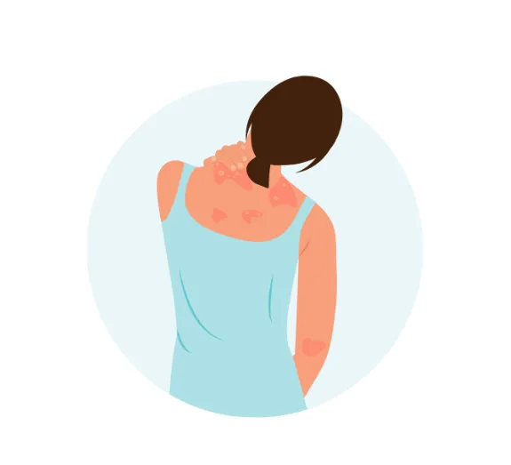 Atopic Dermatitis Survey